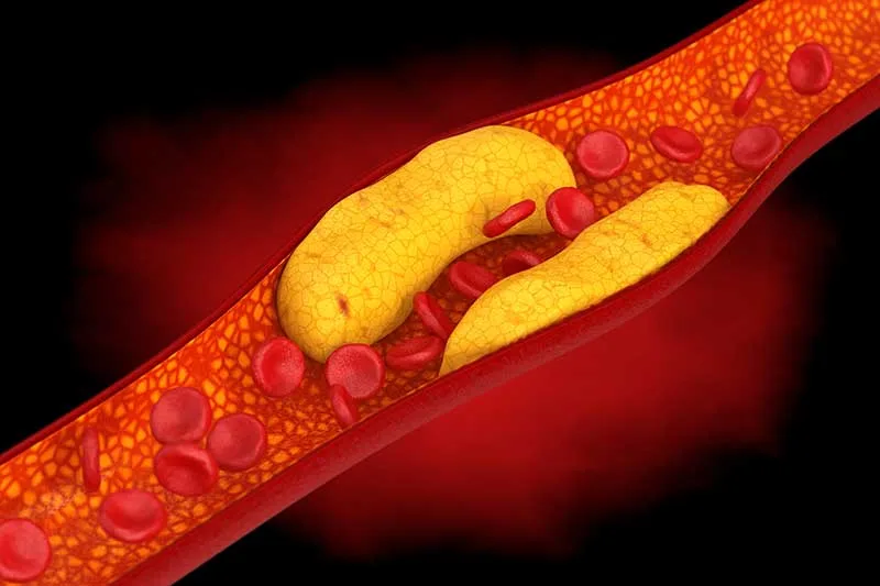 Fat Deposits Blocking The Flow of Blood